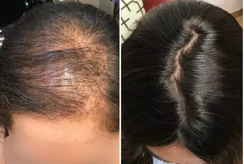 Before and after: thinning crown to full coverage